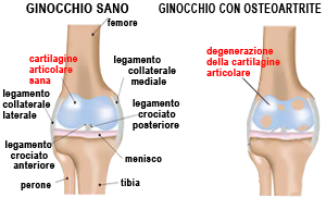 Curare la gonoartrosi con l'ozonoterapia